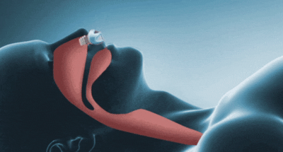 Portable Micro CPAP — Quiet Anti-Snore Sleep Aid 6